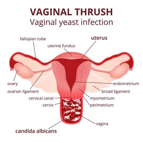 Candidal Vulvovaginitis