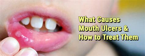 What Causes Mouth Ulcers and How to Treat Them