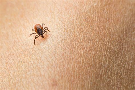 These horrifying pictures show the exact tick bite symptoms to look for