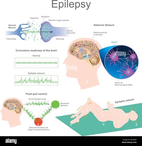 Epilepsy is a group of neurological disorders characterized by epileptic seizures. Epileptic ...