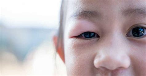 Children's Stye | Causes, Symptoms & Treatment for a Child's Stye