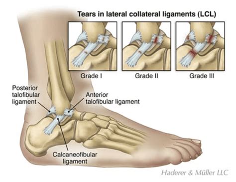 Can You Run with a Sprained Ankle? (Everything You Need to Know)