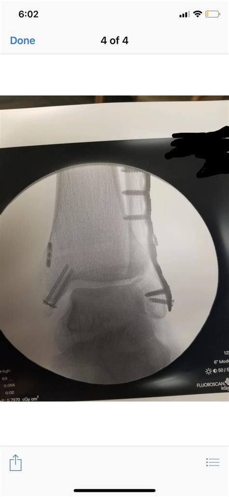 Thoughts on my post ORIF ankle ? : r/surgery