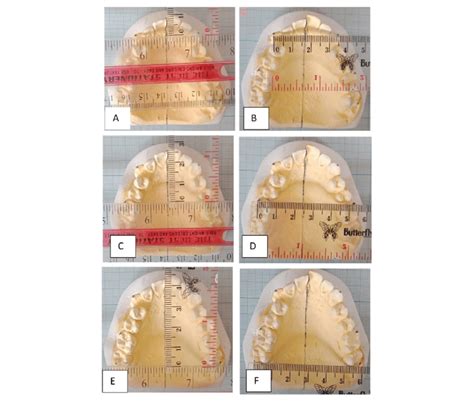 Measurement of upper dental arch form. The sagittal dental arch from ...