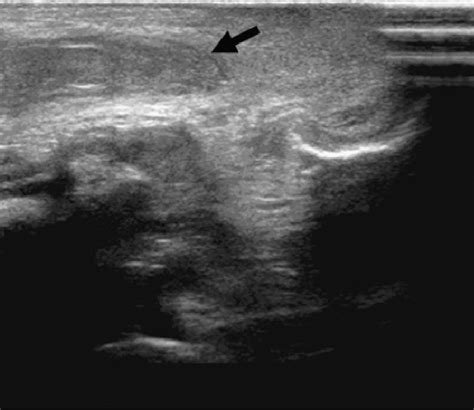 Scrotal ultrasonography showed right scrotal hematoma (arrow). | Download Scientific Diagram