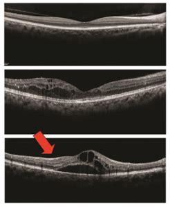 What is Macular Edema? - Retina Specialist - Buffalo New York - Back of the Eye MD