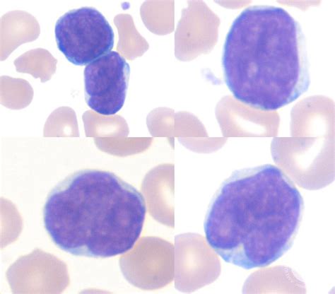 Pediatric lymphocytes