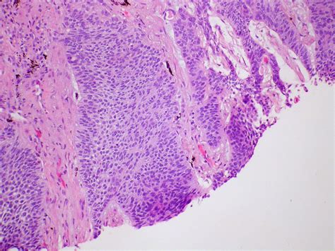 Basaloid squamous cell carcinoma Case 275 Biopsy | A nest of… | Flickr