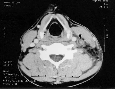 CT scan of the neck revealing thrombosis of the left internal jugular ...