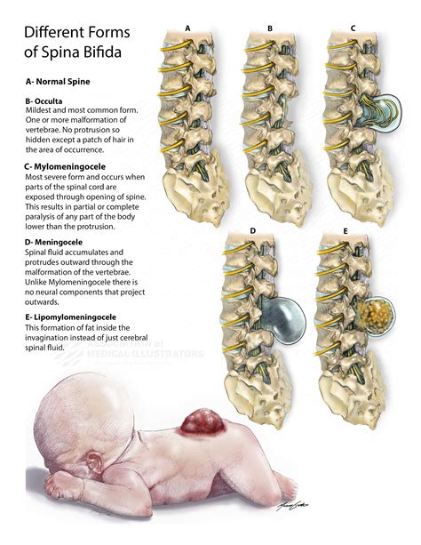 Spina Bifida Occulta Hair Patch