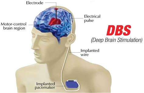 Deep brain stimulation, uses, success rate & side effects