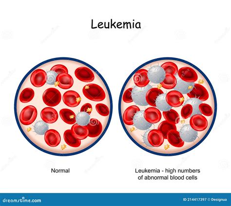 Leukemia. Blood of Healthy Person and Blood Cancer Stock Vector - Illustration of blood ...