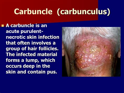 Acute purulent infections of soft tissues. A boil