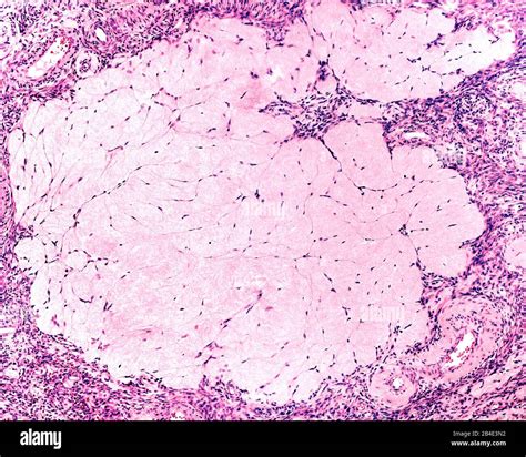 Corpus Albicans Histology