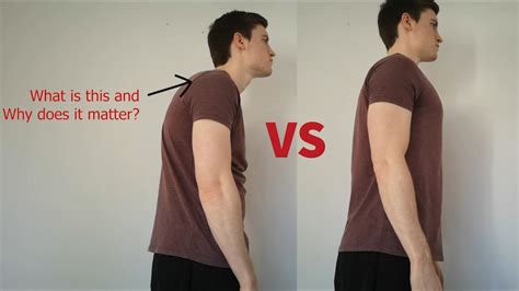 ROUNDED SHOULDERS/NERD NECK - YouTube