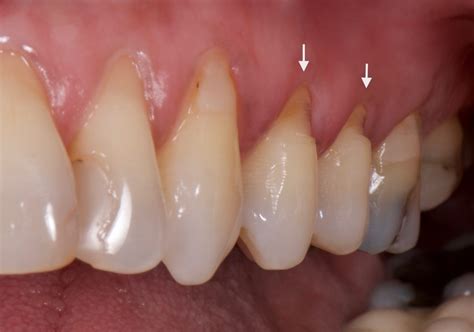 Abfraction - Implants Dubai