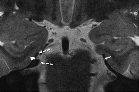 Trochlear Nerve Mri