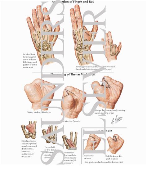 Amputation of Finger and Ray