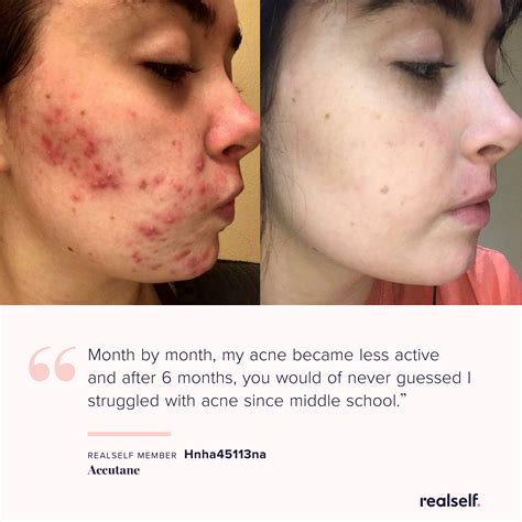 Accutane Side Effects, Uses, Results & More | RealSelf | Acne treatment ...