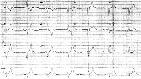 Complete heart block with a ventricular escape rhythm of 40 beats per... | Download Scientific ...