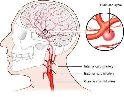 Brain Aneurysm- Detection and Treatments - Ace Medical Co