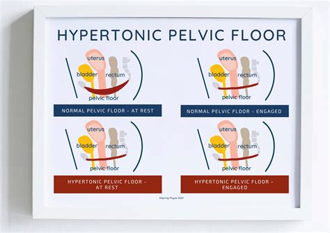 Pelvic Floor Physical Therapist Poster Hypertonic Pelvic Floor Pelvic ...