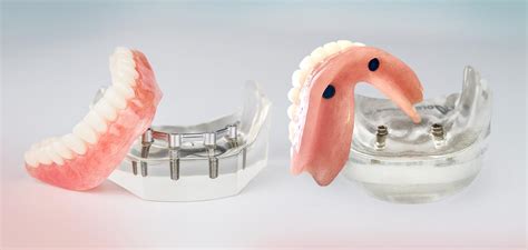 Implant Supported Vs Implant Retained Dentures - tacitceiyrs