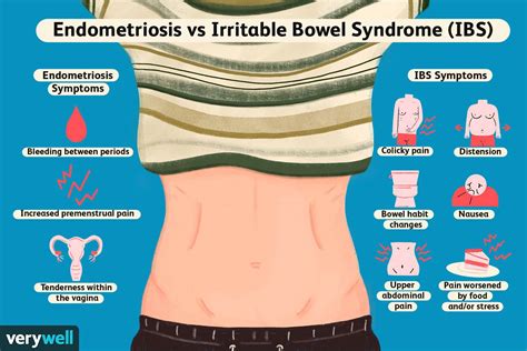 Irritable Bowel Syndrome Stool