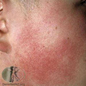 Keratosis Pilaris Treatment - Colorado Springs & Monument, CO