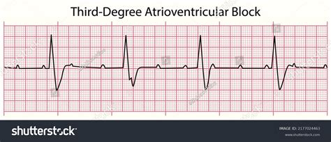 Third Degree Heart Block