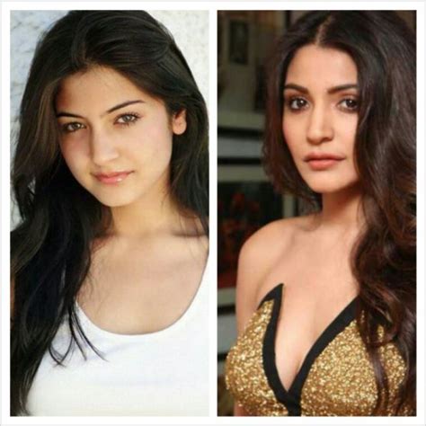 Anushka Sharma Plastic Surgery Rumors