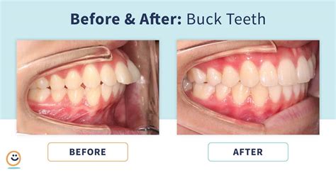 Braces: Before and After Buck Teeth