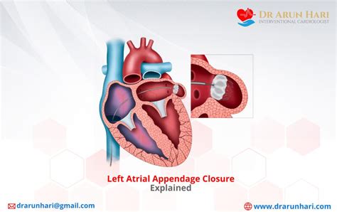 Left Atrial Appendage Closure Explained - Dr Arun Hari