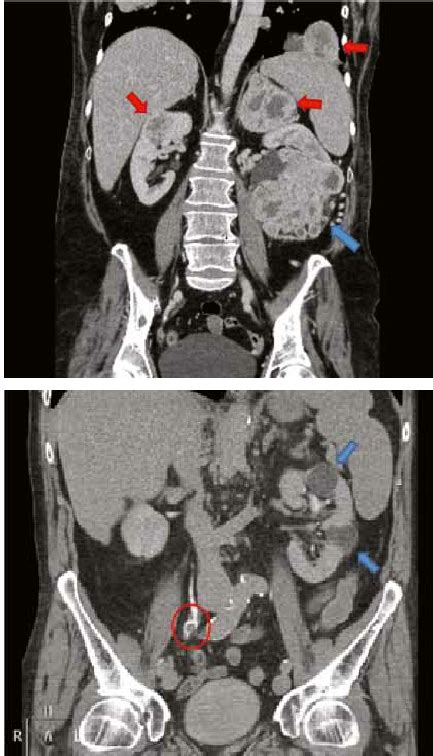 Coronal CT urogram (delayed phase) demonstrating a right ureteric ...