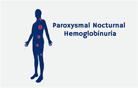 FDA approves Empaveli for treatment of paroxysmal nocturnal hemoglobinuria - Newspostalk ...