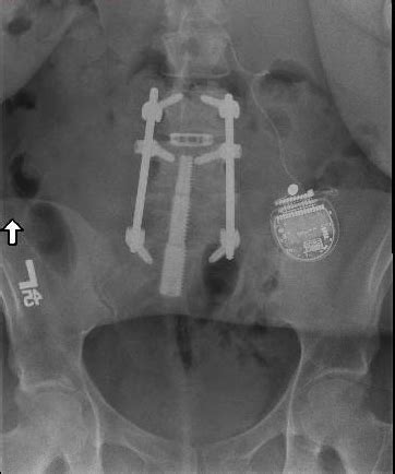 Revision Surgery after Failed Axialif | Houston Scoliosis & Spine Institute