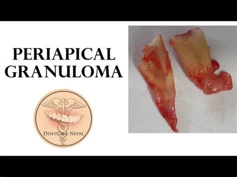 Periapical Granuloma of Teeth- Oral Pathology - YouTube