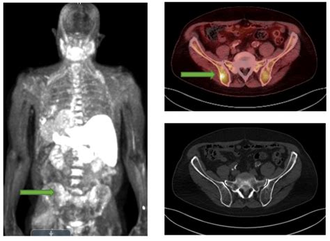 PET/CT For Prostate Cancer - Charter Radiology