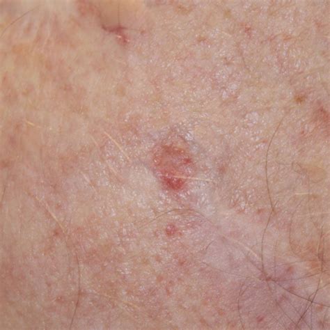 What is Basal Cell Carcinoma?