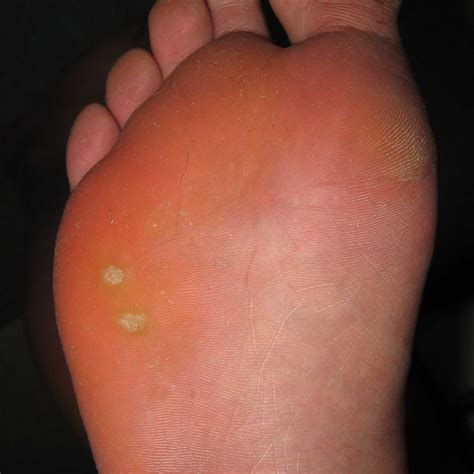 Can You Recognize Plantar Warts on Feet?