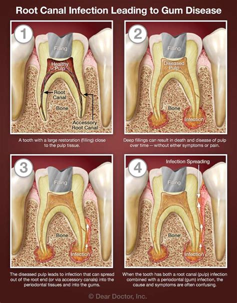 Combined Root Canal & Gum Problems | Dental Innovations | Mark D ...