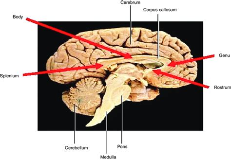 Mid-sagittal view of the cadaveric brain showing the corpus callosum... | Download Scientific ...