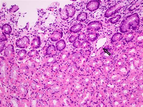 Portal Hypertension Histology