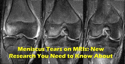 Meniscus Tear MRI? - Please Read This