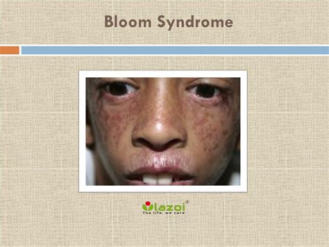 PPT - Bloom Syndrome PowerPoint Presentation, free download - ID:7929298