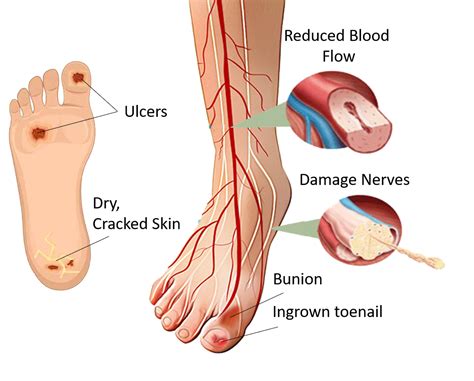 Diabetic Foot Ulcer