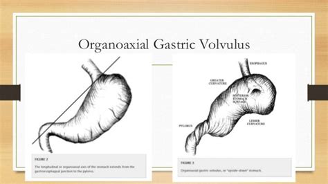 Pediatric Gastric Volvulus