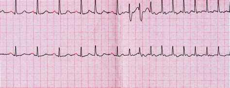 Heart Rhythms: What's Normal Versus Cause for Concern? | Johns Hopkins Medicine