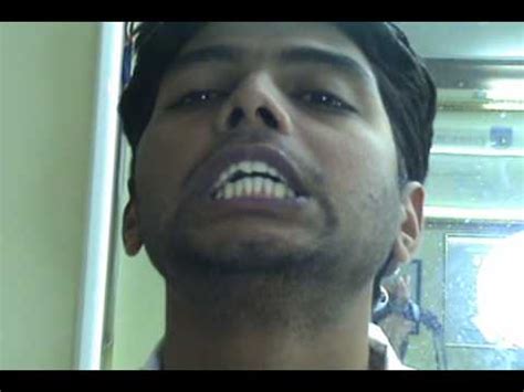 BUCK TEETH CORECTED IN 3 MINUTES IN INDIA WITH ASTHETIC DENTAL ACUPUNCTURE - YouTube