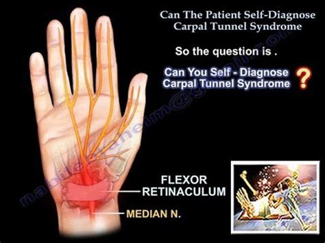 Carpal Tunnel Syndrome Diagram